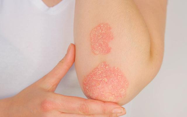 Psoriasis & Eczema Program