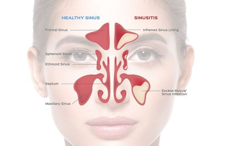 Sinusitis